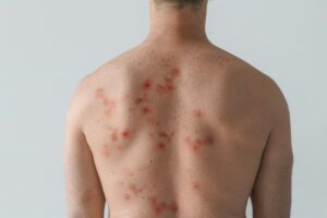 How To Take Ivermectin For Scabies